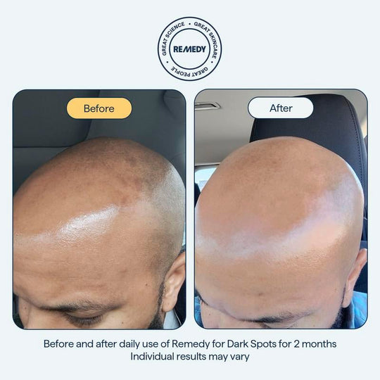 😴😴REMEDY Yön yli -seerumi: Voimanpesäsi taistelussa tummia läiskiä vastaan