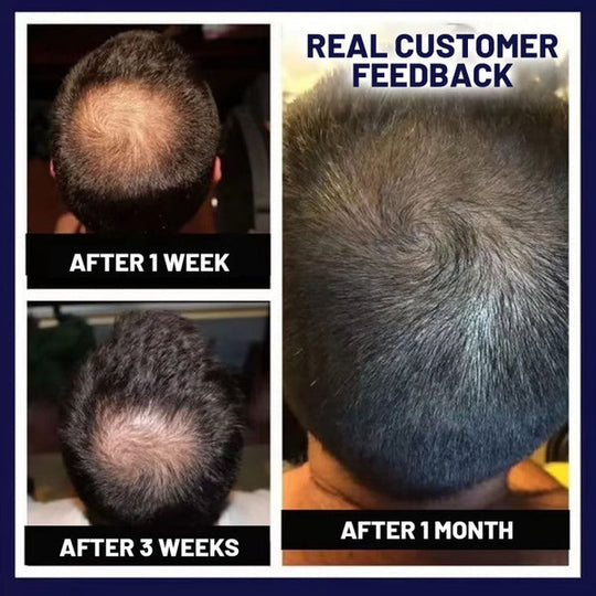 🖤Crni petak: 40% popusta🖤 HZA™ Sprej za ponovni rast prirodne kose