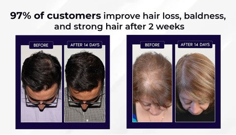 🖤Crni petak: 40% popusta🖤 HZA™ Sprej za ponovni rast prirodne kose