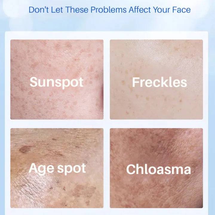 Age Spot Essence Milk Forbedrer hudpigmentering Yello Essence Cream til reduktion af alderspletter