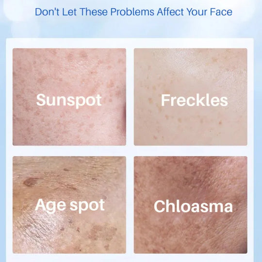 Age Spot Essence Milk Forbedrer hudpigmentering Yello Essence Cream til reduktion af alderspletter
