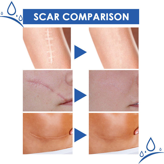 Scar Repair Cream for Men and Women, fade scars and tighten skin in one step
