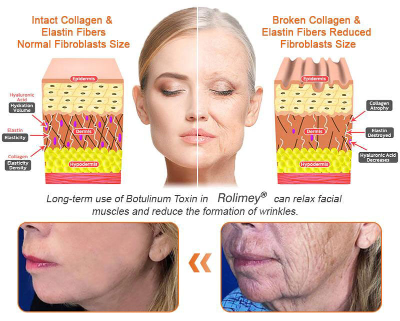 🧑‍⚕️𝑶𝒇𝒇𝒊𝒄𝒊𝒂𝒍 𝑺𝒕𝒐𝒓𝒆 | 𝐑𝐨𝐥𝐢𝐦𝐞𝐲® 𝐁𝐨𝐭𝐨𝐱 𝐁𝐞𝐞 𝐕𝐞𝐧𝐨𝐦 𝐅𝐢𝐫𝐦𝐢𝐧𝐠 𝐒𝐞𝐫𝐮𝐦 𝐒𝐭𝐢𝐜𝐤 - 𝐓𝐚𝐫𝐠𝐞𝐭𝐬 𝐒𝐚𝐠𝐠𝐢𝐧𝐠 𝐒𝐤𝐢𝐧 &  Det er ikke engang, du kan lide det. 𝐑𝐞𝐬𝐮𝐥𝐭𝐬 𝐢𝐧 𝟑 𝐃𝐚𝐲𝐬