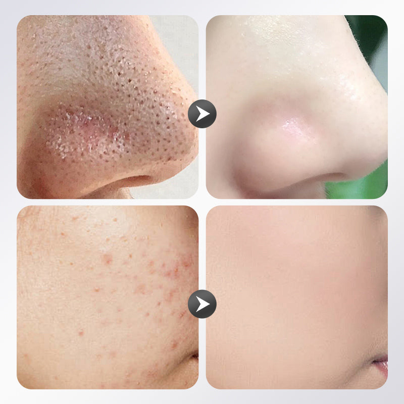 40g Azelaic Acid Clay Mask Stick