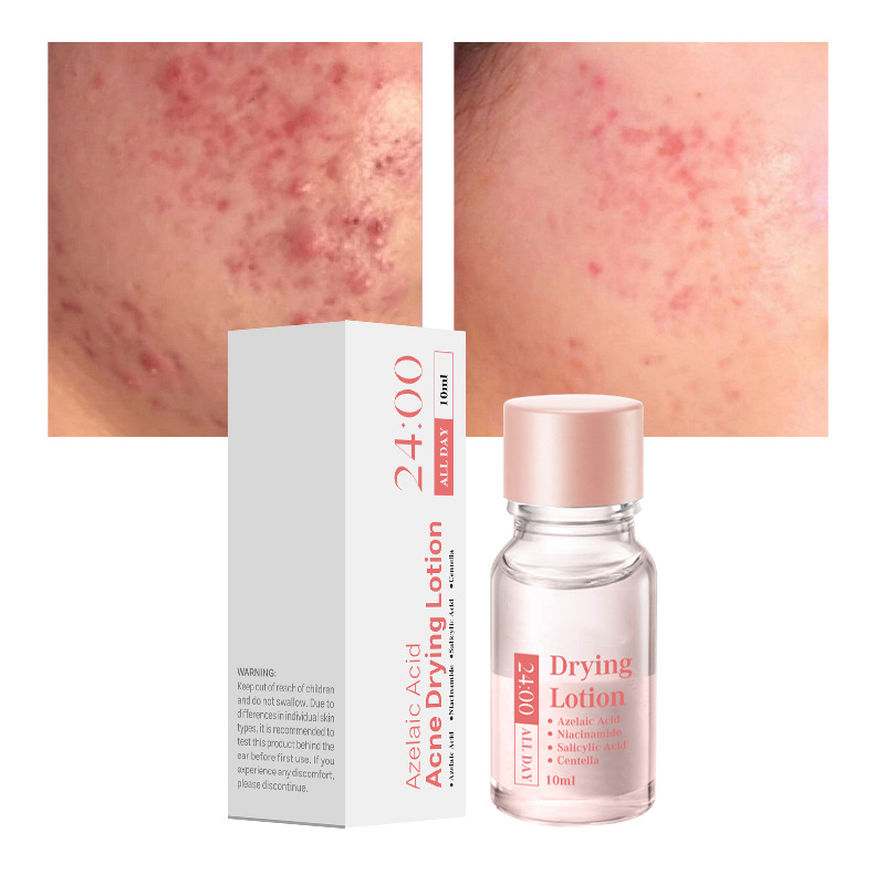 Dr.Leo 24H Acne & Pimple Treatment Drying Lotion | Inflammation Relief, Post-Blemish Care & High Pressure Pimple Relief