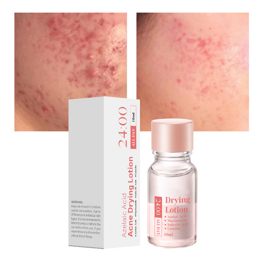 Dr.Leo 24H Acne & Pimple Treatment Drying Lotion | Inflammation Relief, Post-Blemish Care & High Pressure Pimple Relief